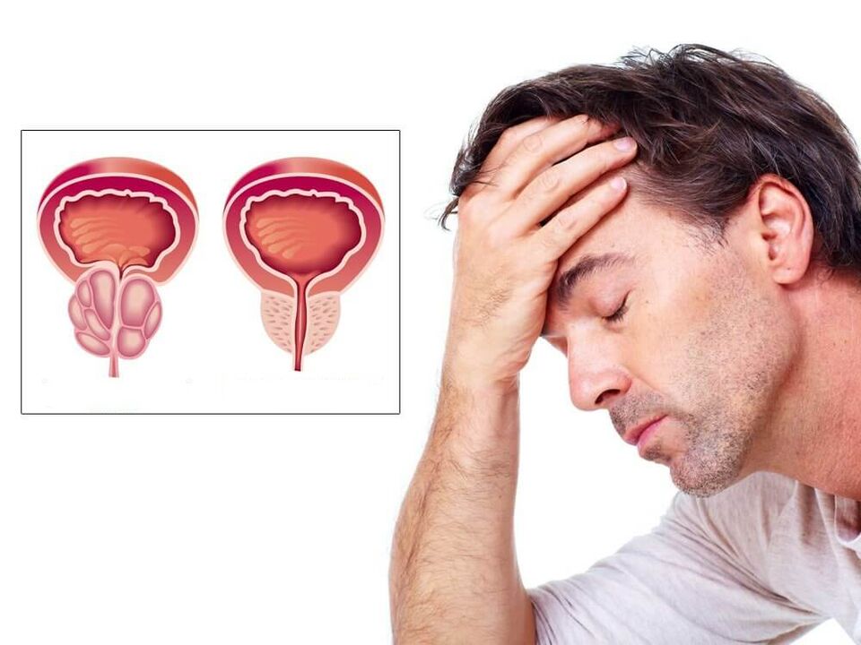 симптоми на простатит при мъжете