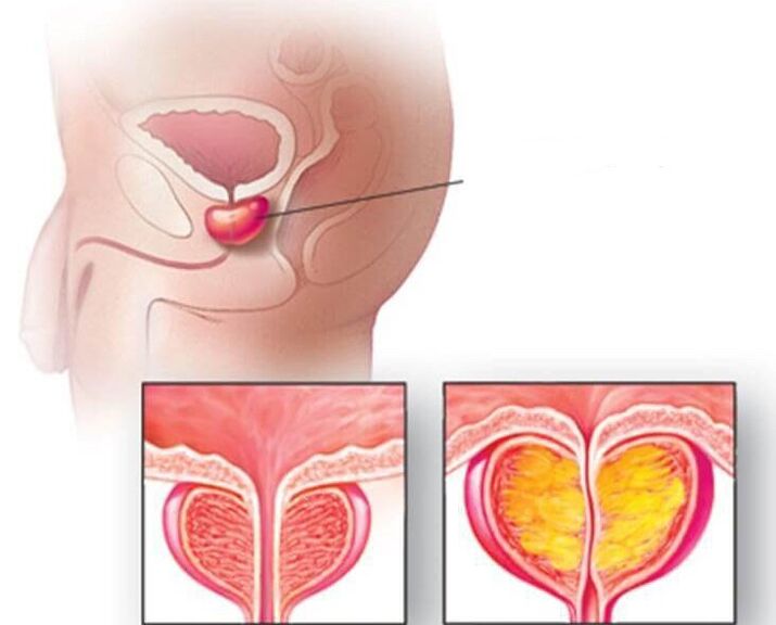 Местоположение на простатната жлеза, нормална простата и увеличена при хроничен простатит