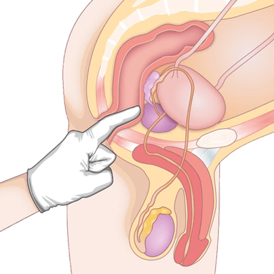 Определяне на състоянието на простатата чрез палпация за диагностика на простатит