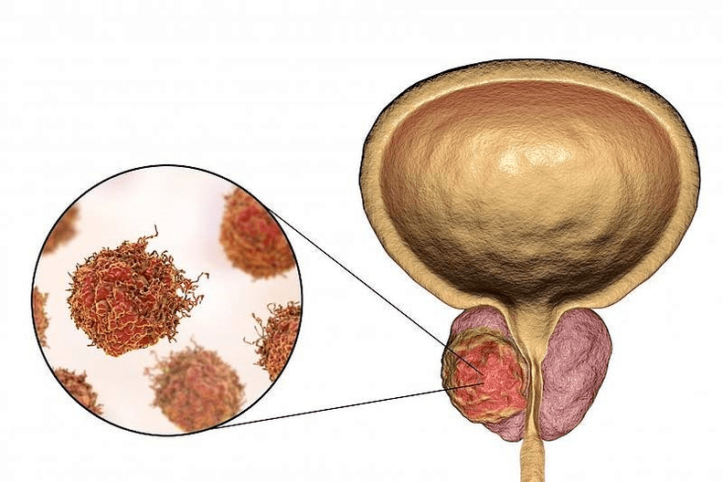 как изглежда увреждането на простатата